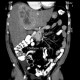 Liver carcinoid: CT - Computed tomography